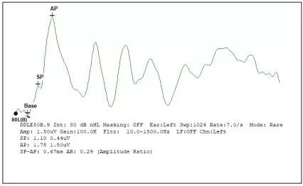 SP/AP Amplitude Ratio Graph