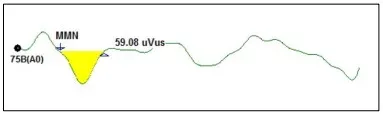MMN Waveform Graph