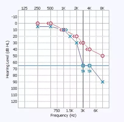 ten-test-audiogram