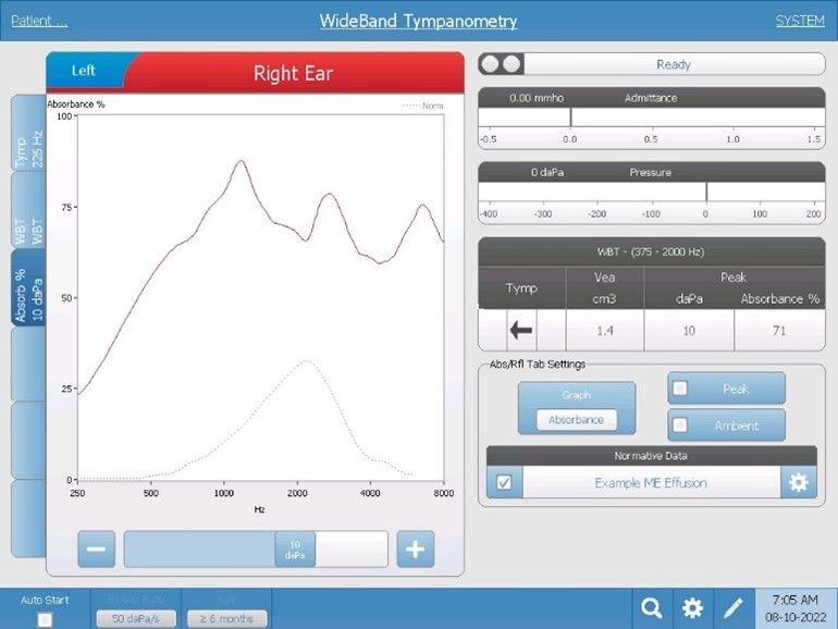 wideband-middle-ear-effusion