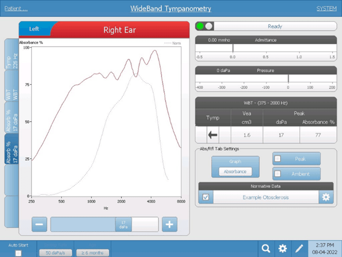 wideband-otosclerosis