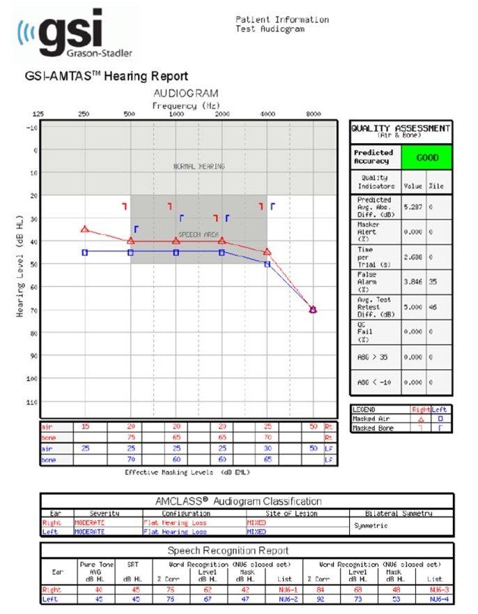 An audiogram generated by GSI AMTAS Pro